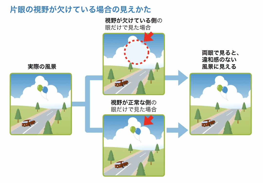 片眼の視野が欠けている場合の見えかた